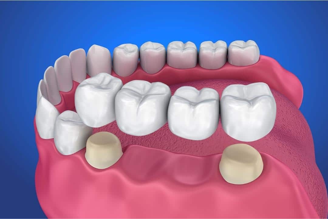 Dentist In Brampton Crowns and Bridges