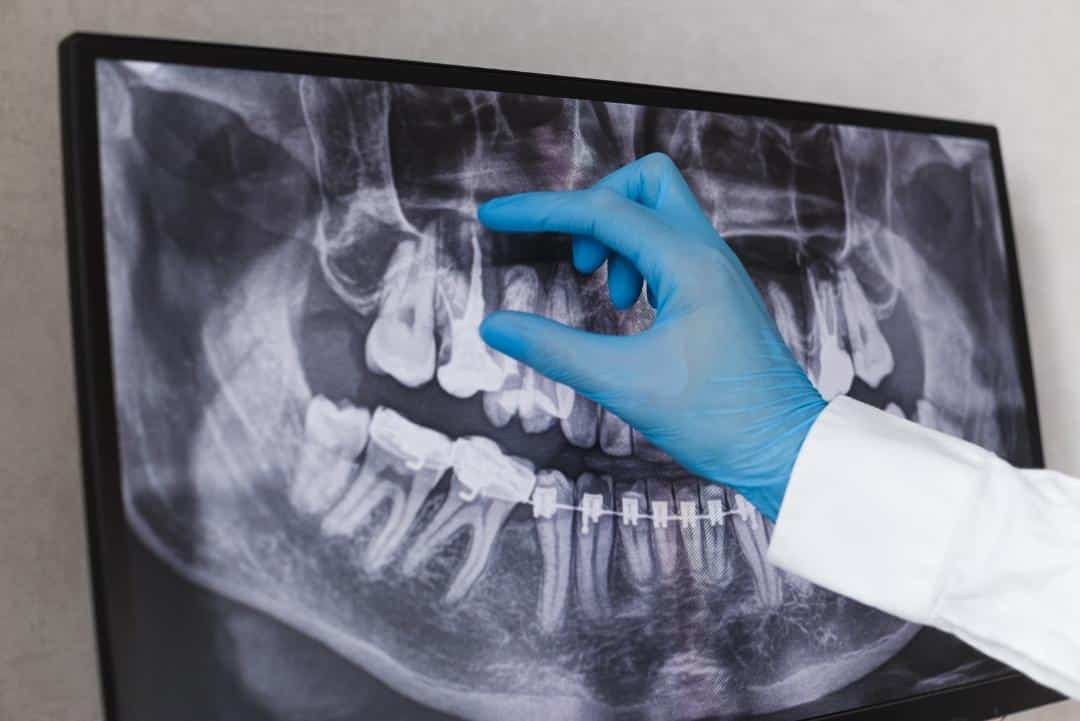 Dentist In Brampton Root Canal